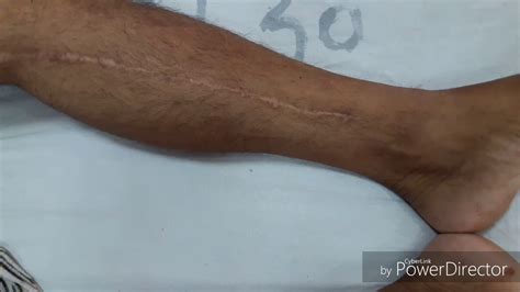 Great Saphenous Vein Scar Mark for Coronary Artery Bypass Graft - CABG - YouTube