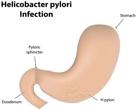 Stomach Polyps: Symptoms, Causes, Diet, Treatment | STD.GOV Blog