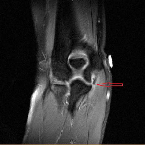 right elbow Mri with contrast showing complete tear of the UCL ...