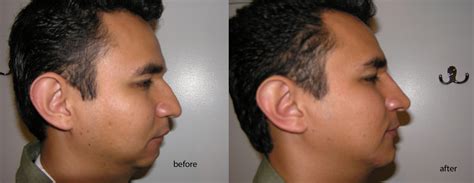 A Detailed Guide About Top 10 Best Double Chin Treatments With ...