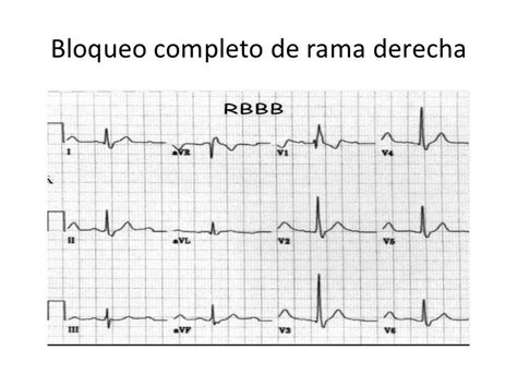 Bloqueos de rama y bloqueos fasciculares