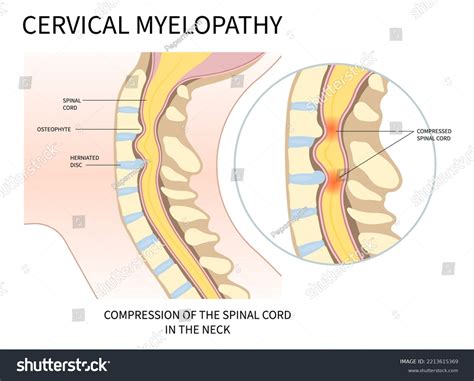 Cervical Nerve Root Compression That Cause Stock Vector (Royalty Free) 2213615369 | Shutterstock