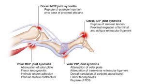 Finger injury series – Swan-neck deformity - Physio Plus