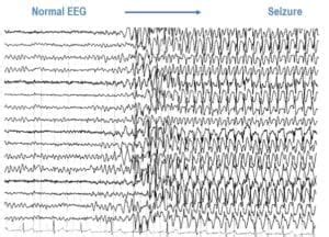 Photosensitive Epilepsy - Epilepsy Action Australia