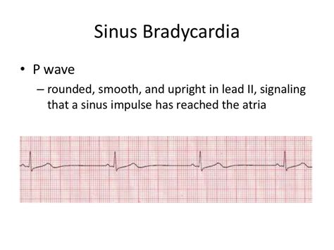 Sinus bradycardia