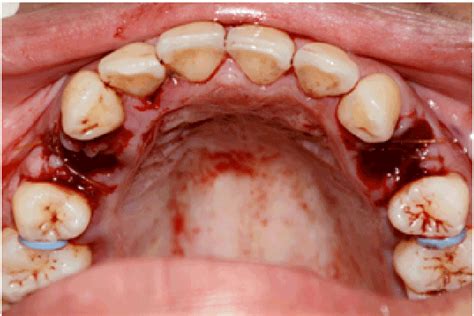 The Effects of Using Hyaluronic Acid on the Extraction Sockets