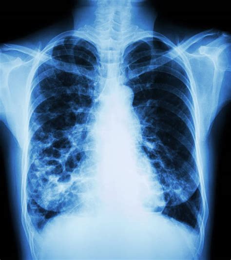 Chronic Bronchitis Chest X Ray Stock Photos, Pictures & Royalty-Free ...