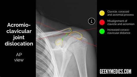 Shoulder X-ray Interpretation | Radiology | Geeky Medics