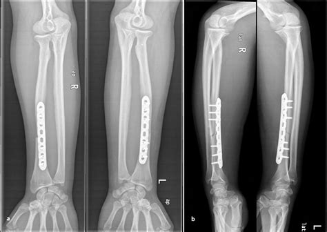 Galeazzi Fracture Classification