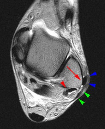 Peroneal Tendon Dislocation and Superior Peroneal Retinaculum Injury ...