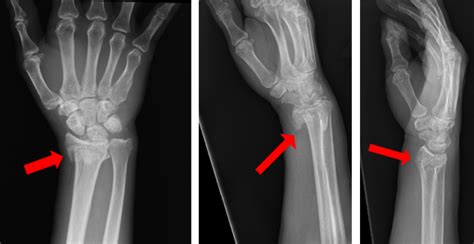 Distal Radius Fracture (Broken Wrist) | Orthopaedic Trauma Association (OTA)