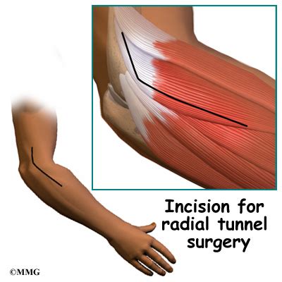 Radial Tunnel Syndrome | eOrthopod.com