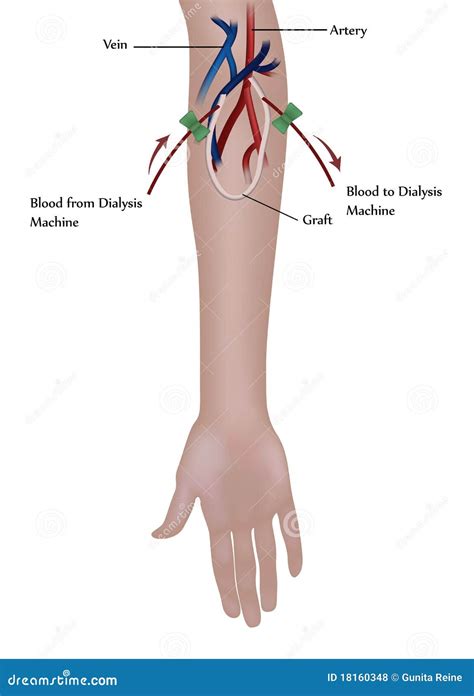 Hemodialysis procedure stock vector. Illustration of graft - 18160348