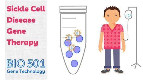 Gene Therapy for Sickle Cell Disease - Modification of Stem Cells - YouTube