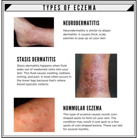 √70以上 eczema types on arms 105938-What is eczema on arms