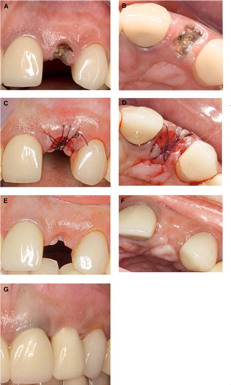 Figure 1 from Histologic analysis of healing after tooth extraction with ridge preservation ...