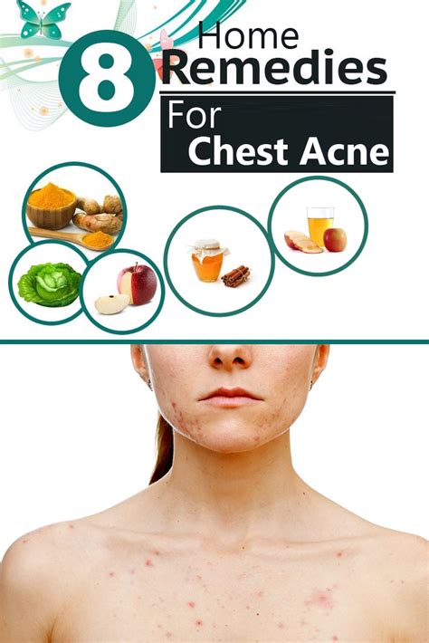 8 Effective Home Remedies For Chest Acne | Search Home Remedy