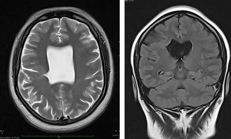 Septo-optic dysplasia with schizencephaly – Radiology Cases