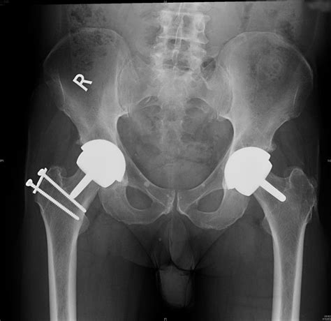 Post-operative X ray of patient showing Hip resurfacing done through ...