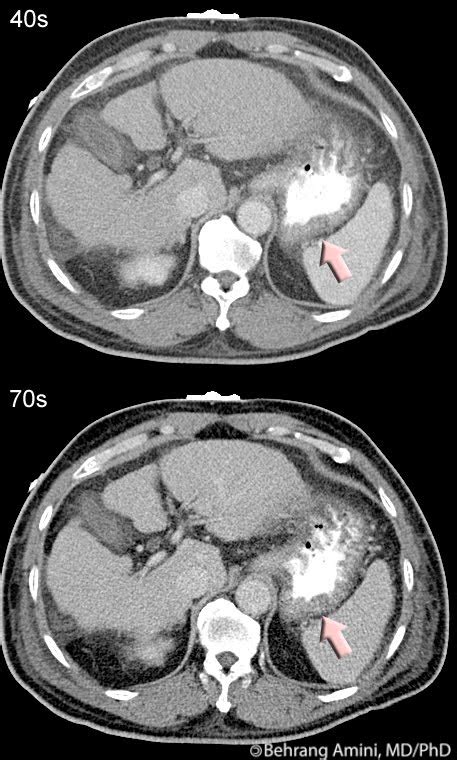 Roentgen Ray Reader: Portal Hypertensive Gastropathy