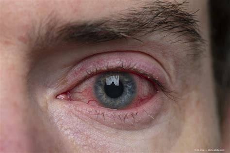 Researchers identify pink eye as possible primary symptom of COVID-19