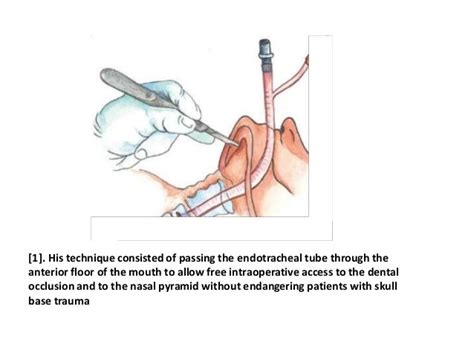 Submental Intubation - (Steps Of The Procedure Explained)