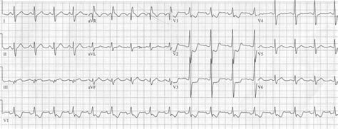 emDOCs.net – Emergency Medicine EducationECG Pointers: Posterior MI - emDOCs.net - Emergency ...