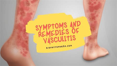 Symptoms And Remedies Of Vasculitis | Biophytopharm