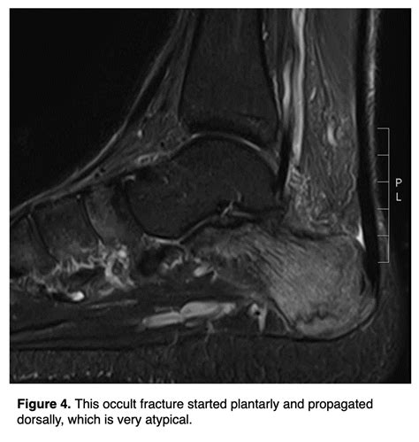 Treating Calcaneal Stress Fractures in Athletes | Podiatry Today