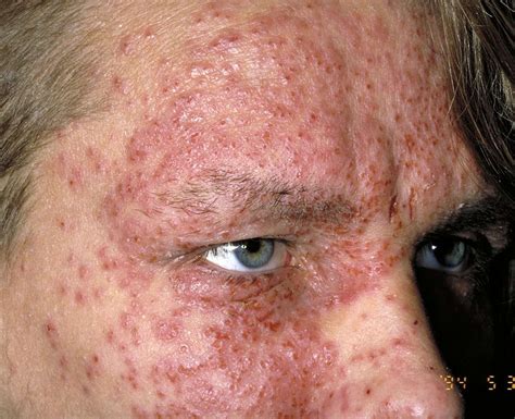 Eczema (Atopic Dermatitis): Overview and More