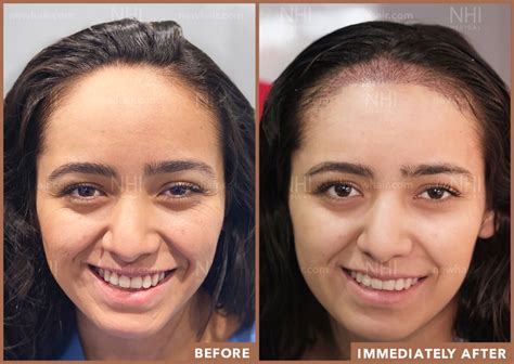 NHI Medical- Hairline Lowering Surgery, New Hair, New You!