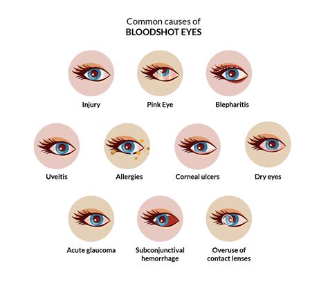 What causes bloodshot eyes? | SmartBuyGlasses IE