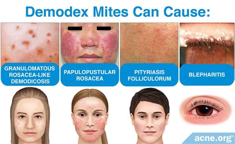 What Are Demodex Mites, and What Role Do They Play in Acne? - Acne.org