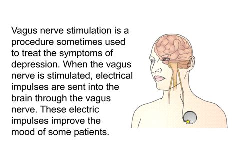 PatEdu.com : Vagus Nerve Stimulation (VNS) for Depression