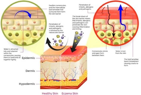 7 Types Of Eczema