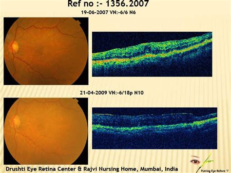 Drushti|Eye and Retina Center:-Idiopathic Cellophane Maculopathy