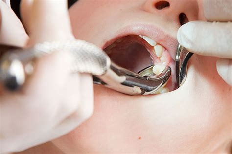 Tooth Extractions Moses Lake - Emergency Tooth Removal WA