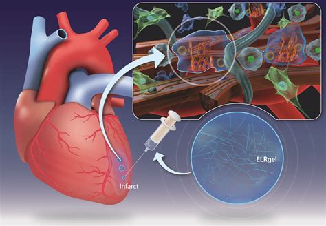 Hydrogel injection may change the way the heart muscle heals after a heart attack - Hospital ...