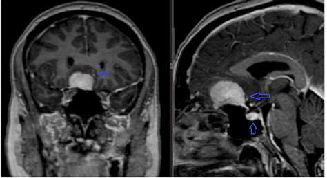 Cureus | Suprasellar Meningiomas: An Experience of Four Cases With ...