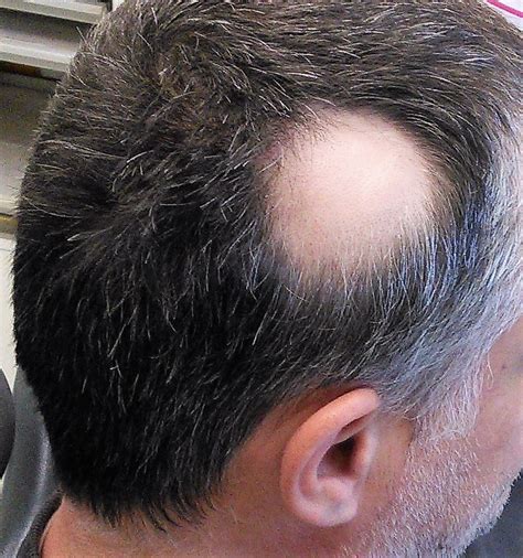 Alopecia | Concise Medical Knowledge