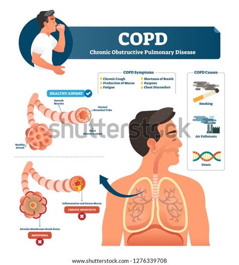 6,874 Lungs In Copd Images, Stock Photos & Vectors | Shutterstock