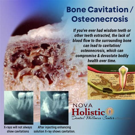 #Cavitation If you've ever had wisdom teeth or other teeth extracted ...