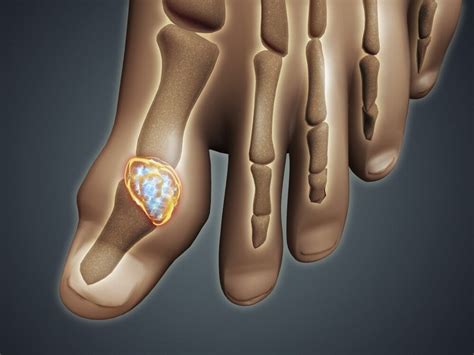 Conceptual image of gout in the big toe. Gout is a form of inflammatory ...