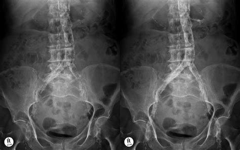 Abdominal Aortic Aneurysm Xray