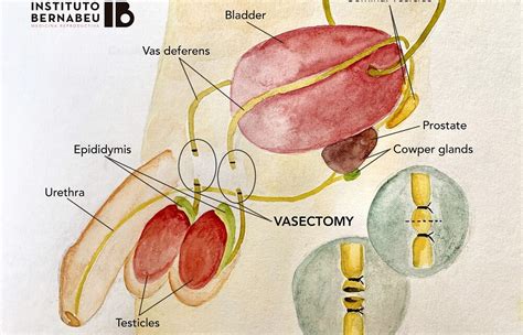 Vasectomies: the male contraceptive