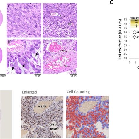 Histopathologic analyses of GBM tumors. A Representative... | Download ...