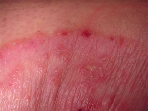 Common Rashes Found in the Armpits