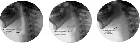 “Hidden in Plain Sight”: A Descriptive Review of Laryngeal Vestibule Closure | Semantic Scholar