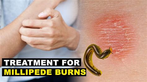 Best Treatment for Millipede Burns - YouTube