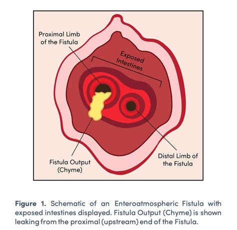 What is an Enterocutaneous Fistula and Enteroatmospheric Fistula?